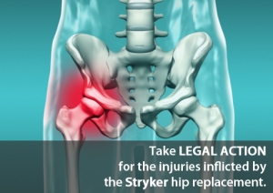 Stryker hip implant